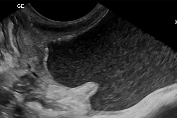 L’échographie d’un bébé.