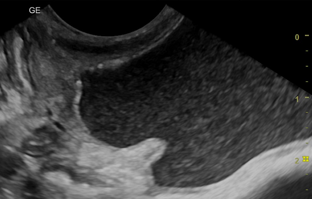 L’échographie d’un bébé.