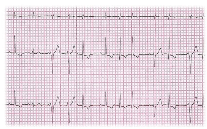 Un graphique montrant une fréquence cardiaque.
