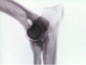 Radiographie d’une articulation du genou.