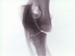 Radiographie d’une articulation du genou.