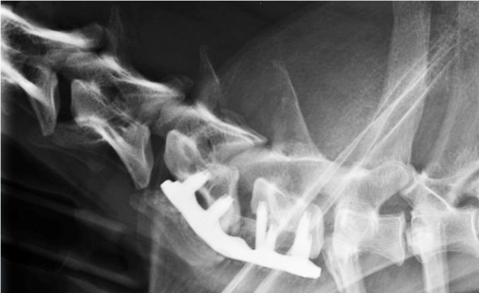 Radiographie d’un crâne avec une vis.