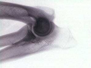 Radiographie d’un os de l’homme.