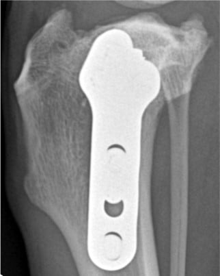 Radiographie d’un os avec une plaque métallique.